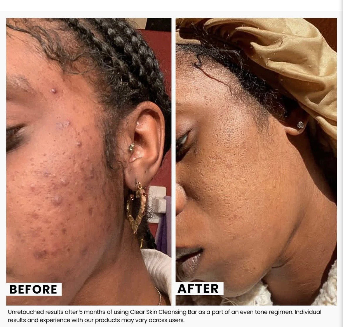 Clear Skin Cleansing Bar