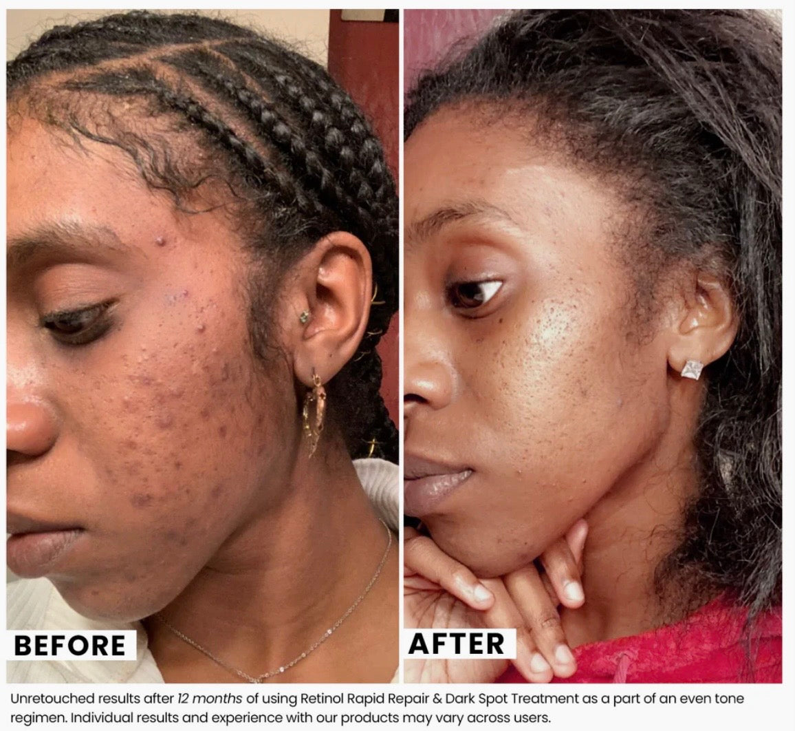 Retinol Rapid Repair Dark Spot Treatment