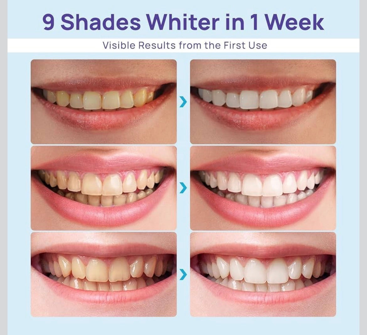 Whitebite Pro Teeth Whitening Kit for Sensitive Teeth