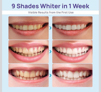 Whitebite Pro Teeth Whitening Kit for Sensitive Teeth