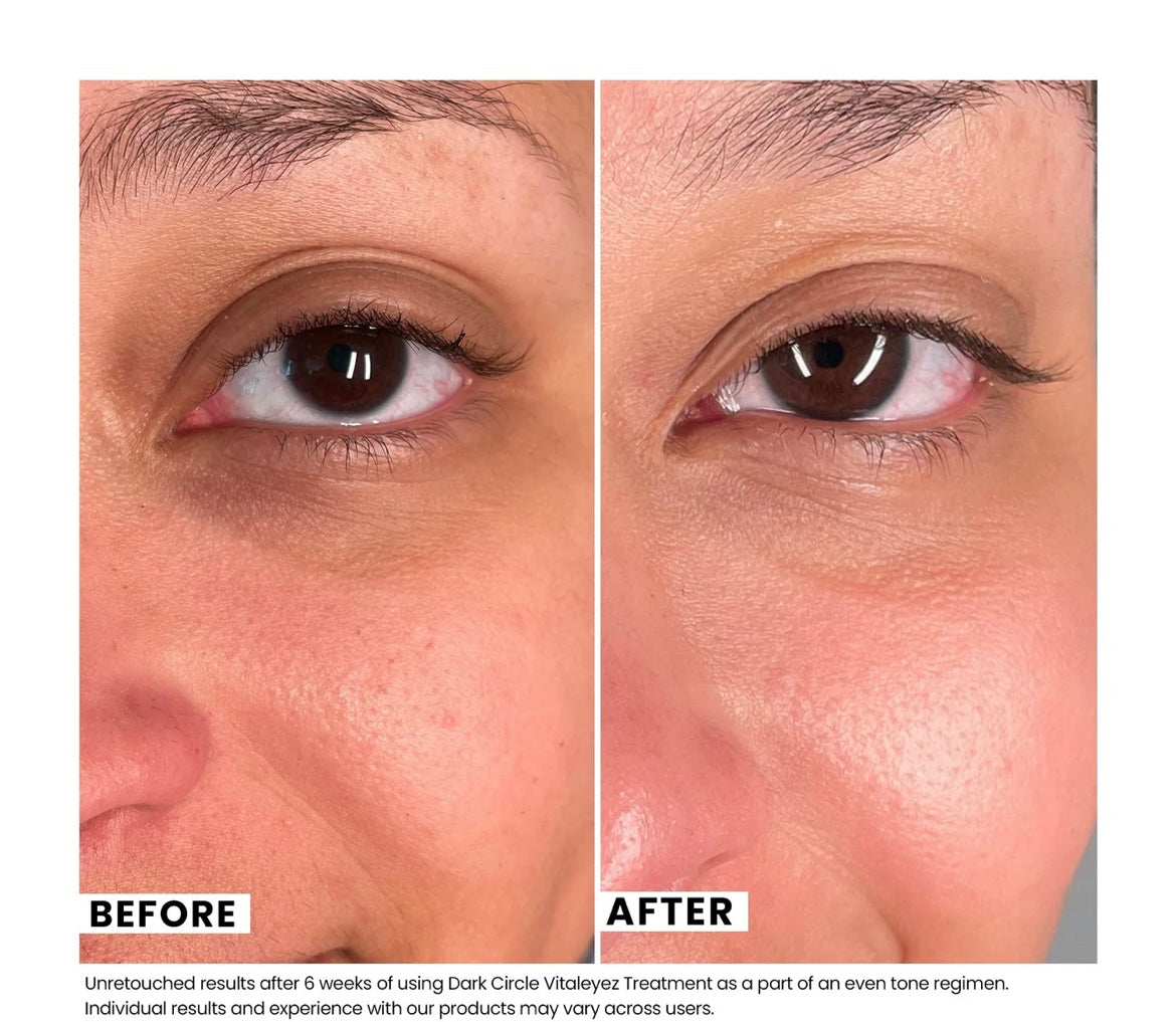 Dark Circle Vitaleyez Treatment