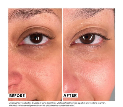 Dark Circle Vitaleyez Treatment